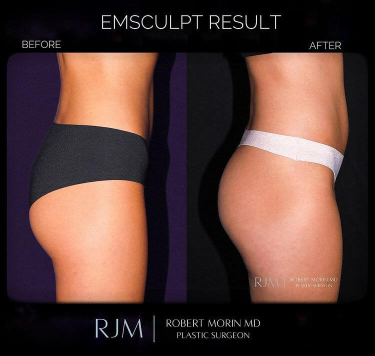 Female Body, before and after Emsculpt treatment, r-side view