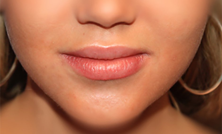 Lip Augmentation - After Treatment Photo - female patient