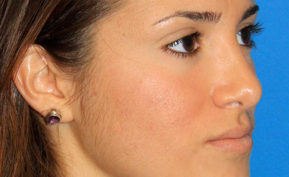 Rhinoplasty - After Treatment Photo - female patient