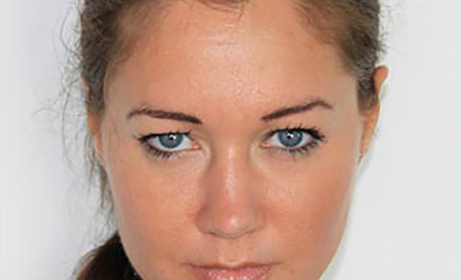 Botox - After Treatment Photo - female patient