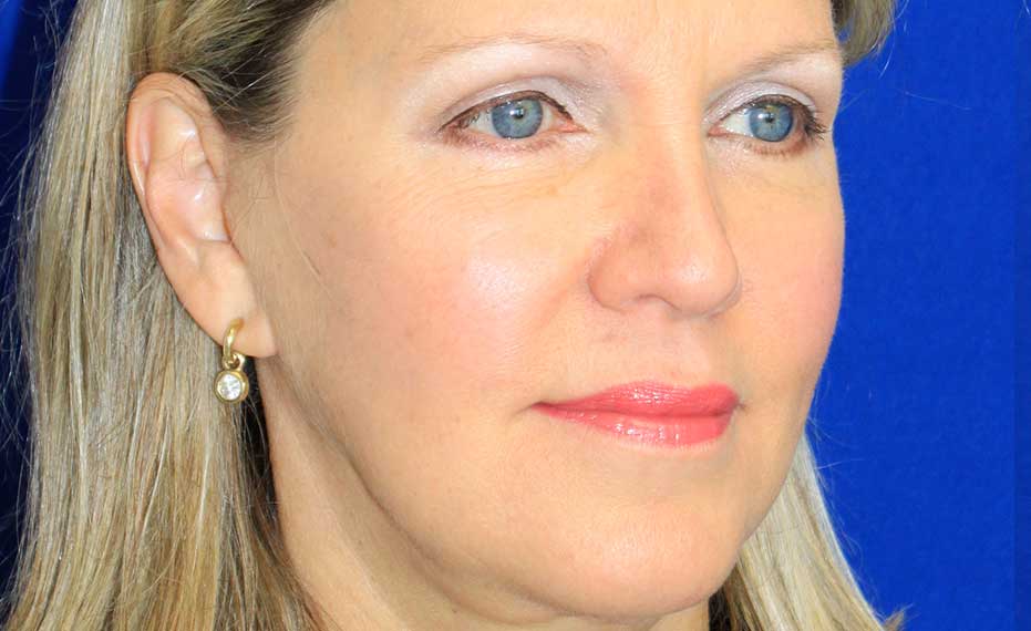 Facelift - After Treatment Photo - female patient