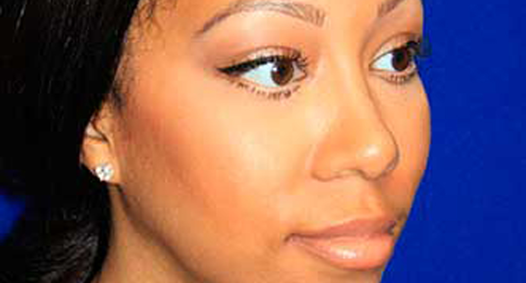 Woman's face, After African American Treatment, oblique view, female patient 1