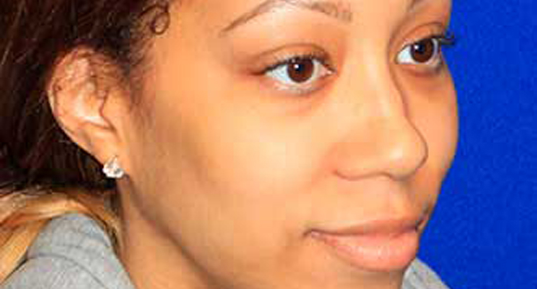 Woman's face, Before African American Treatment, oblique view, female patient 1