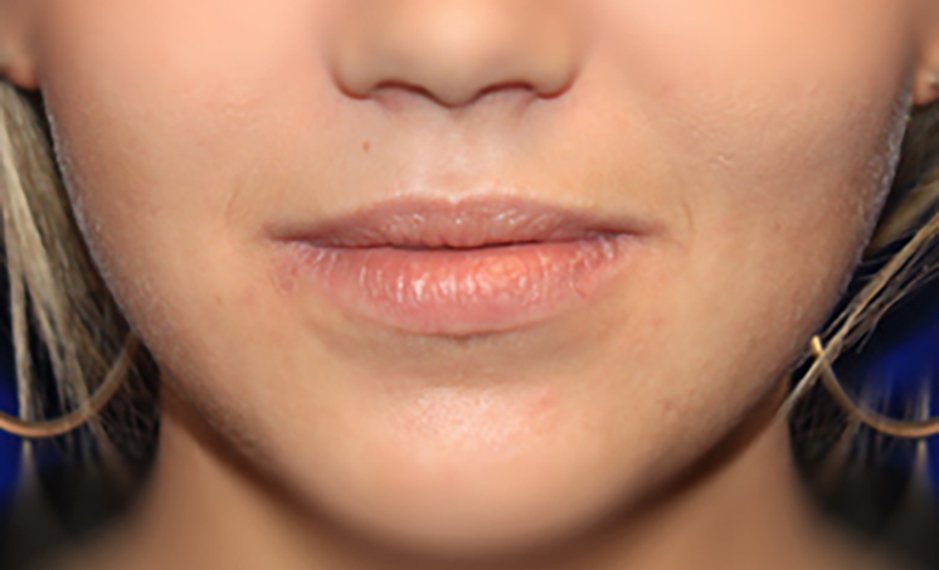 Lip Augmentation - Before Treatment Photo - female patient