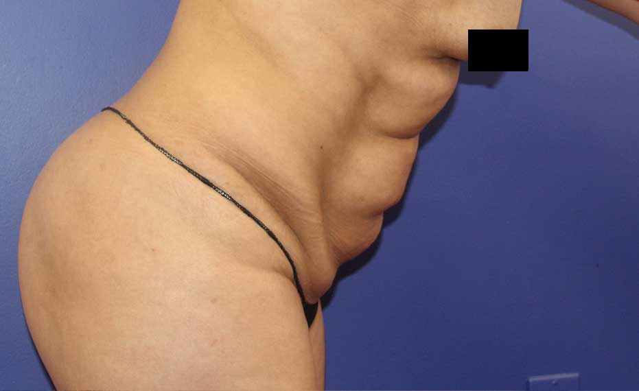 Abdominoplasty - Before Treatment Photo - female patient