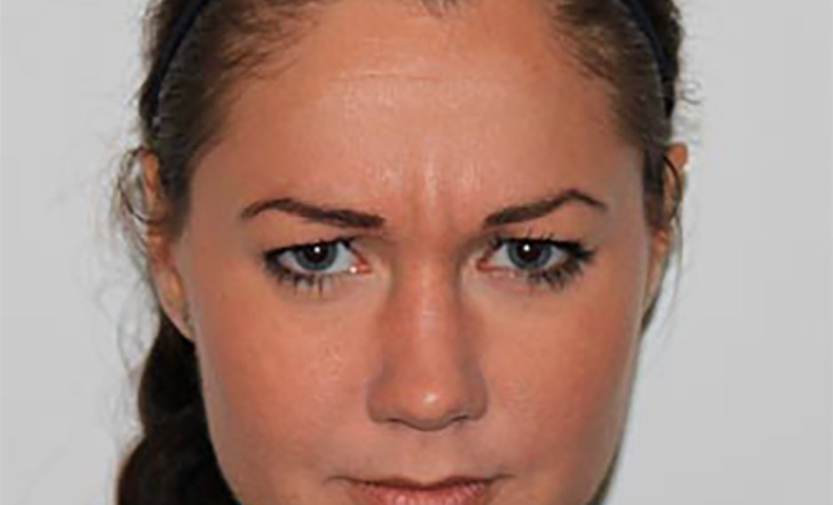Botox - Before Treatment Photo - female patient