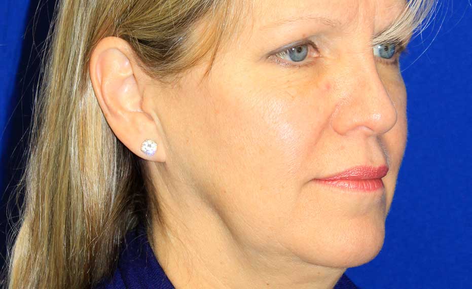 Facelift - Before Treatment Photo - female patient