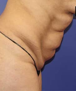 Abdominoplasty Surgery. Treatment photo - female patient 1