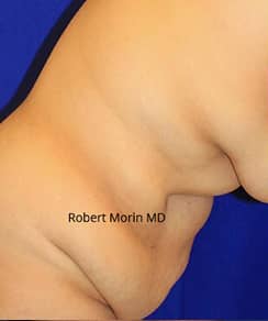 Abdominoplasty Surgery. Treatment photo - female patient 1