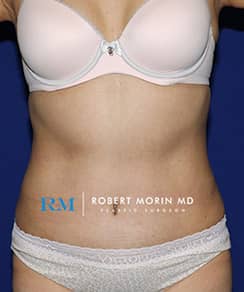 Abdominoplasty Surgery. Treatment photo - female patient 1