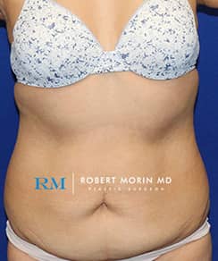 Abdominoplasty Surgery. Treatment photo - female patient 1