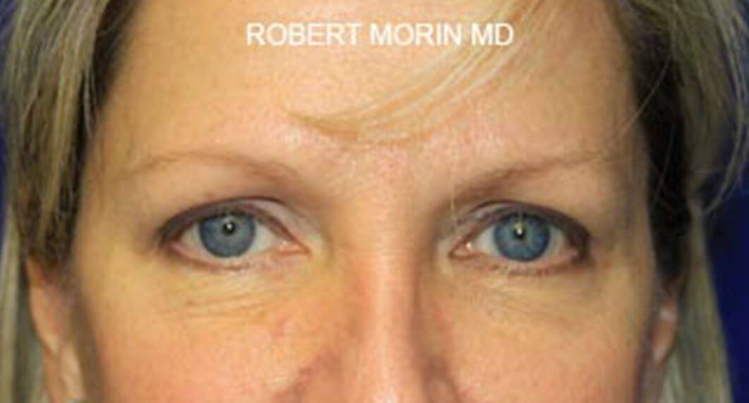 Before Treatment photo - Blepharoplasty - female patient 1