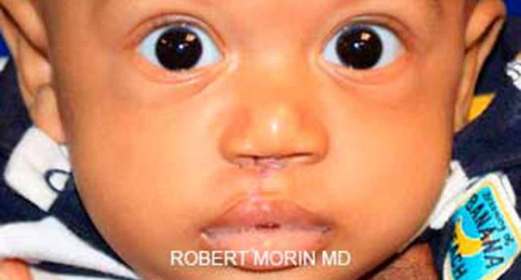 Cleft lip and cleft palate - little child, after treatment photo