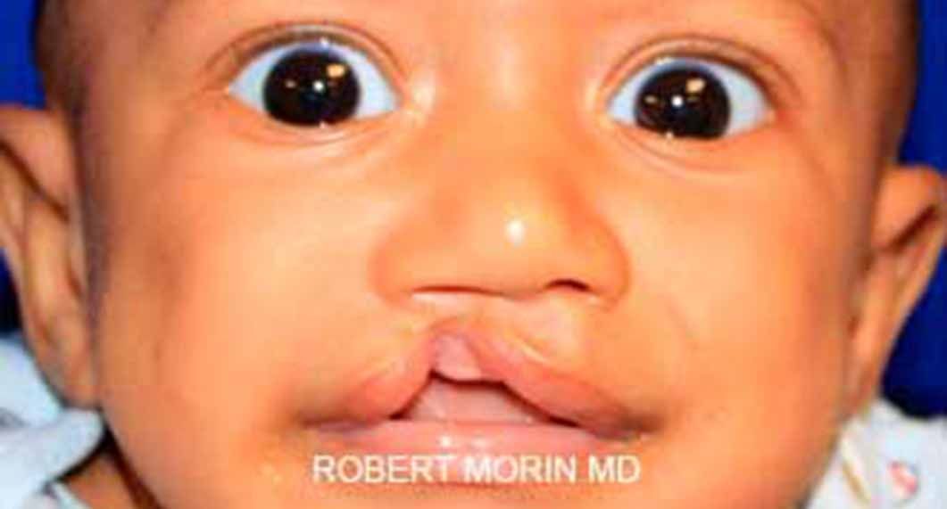 Cleft lip and cleft palate - little child, Before treatment photo
