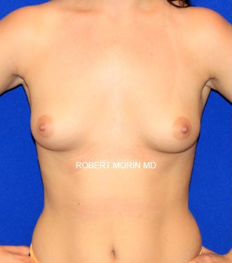 Before Breast Augmentation Treatment photo - female patient 1