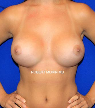 After Breast Augmentation Treatment photo - female patient 1