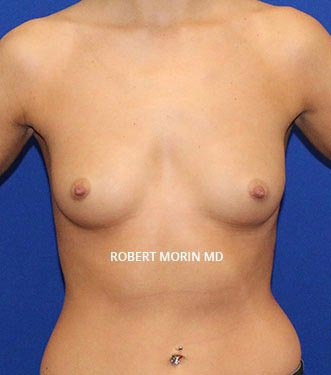 Before Treatment photo - Breast Augmentation - patient 2