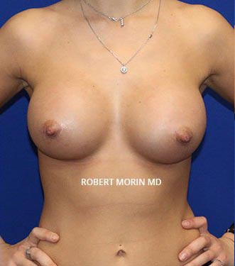After Treatment photo - Breast Augmentation - patient 2