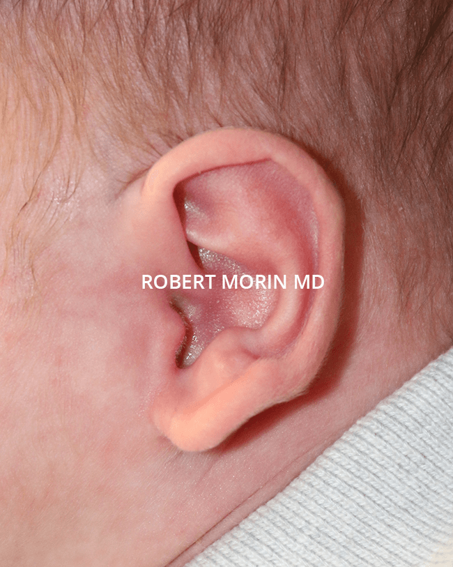 INFANT EAR MOLDING WITH THE EARWELL™ SYSTEM - patient 1