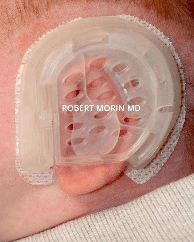 INFANT EAR MOLDING WITH THE EARWELL™ SYSTEM - patient 2