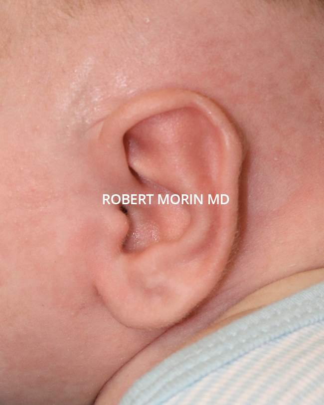 INFANT EAR MOLDING WITH THE EARWELL™ SYSTEM - patient 3