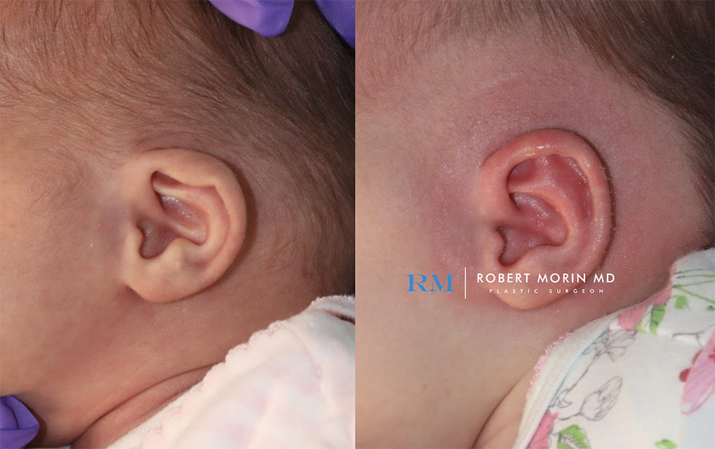 Before and After earwell patient 1
