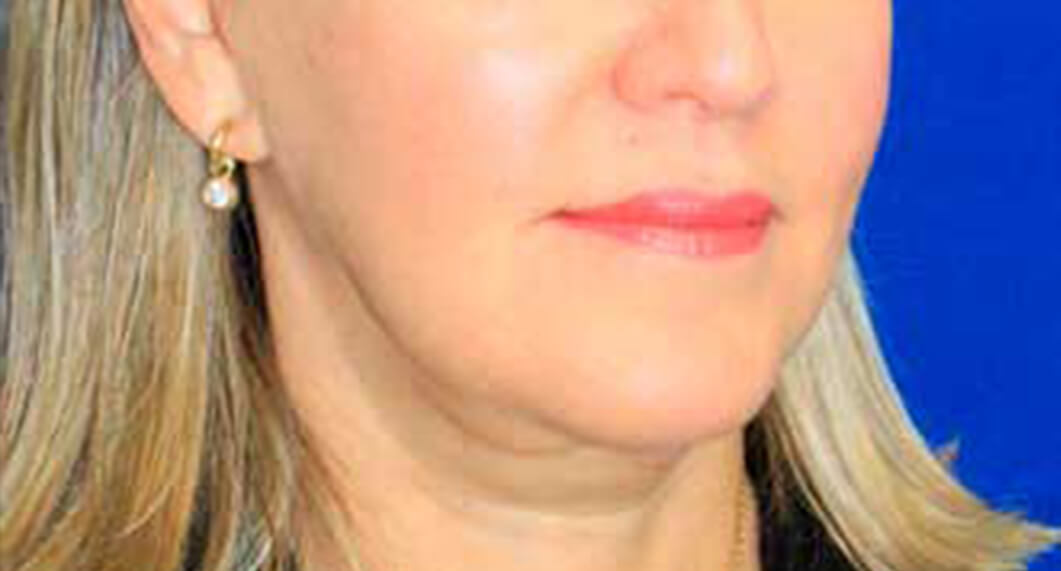 After Treatment photo - Facelift Surgery - female patient 1