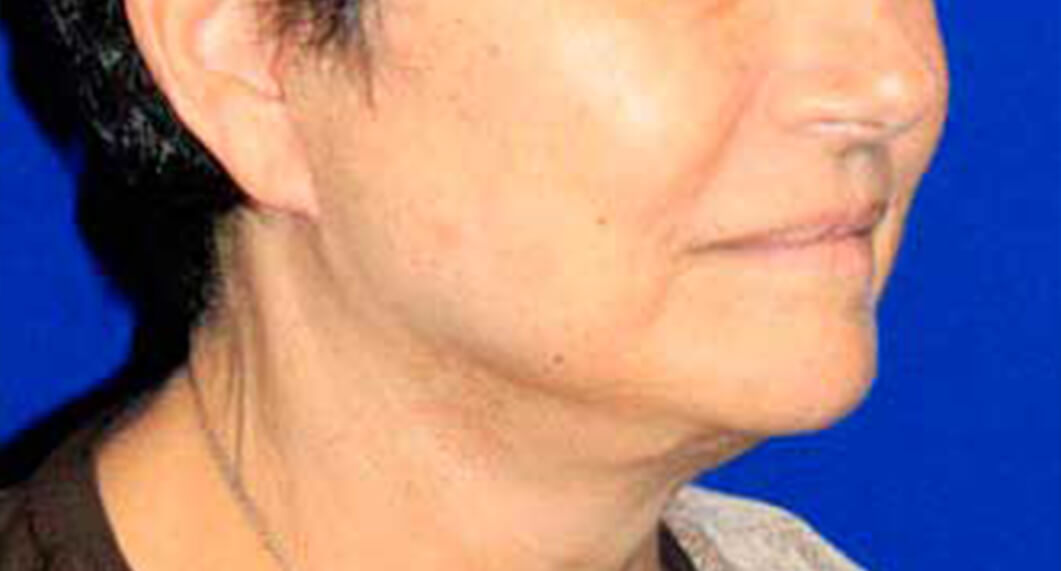 After Treatment photo - Facelift Surgery - female patient 2