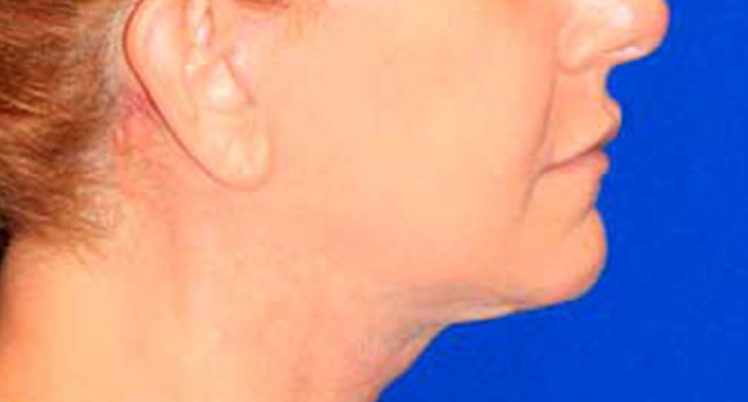 After Treatment photo - Facelift Surgery - female patient 3