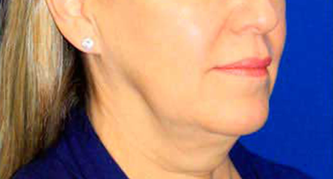 Before Treatment photo - Facelift Surgery - female patient 1
