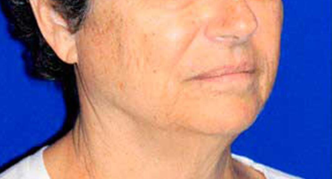 Before Treatment photo - Facelift Surgery - female patient 2
