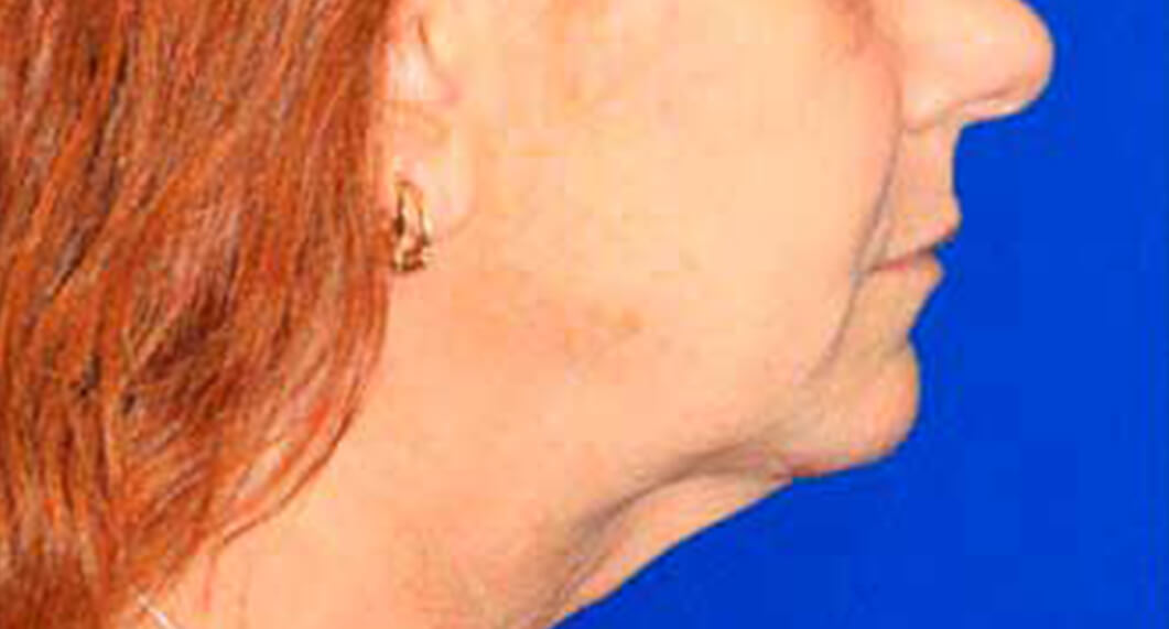 Before Treatment photo - Facelift Surgery - female patient 3