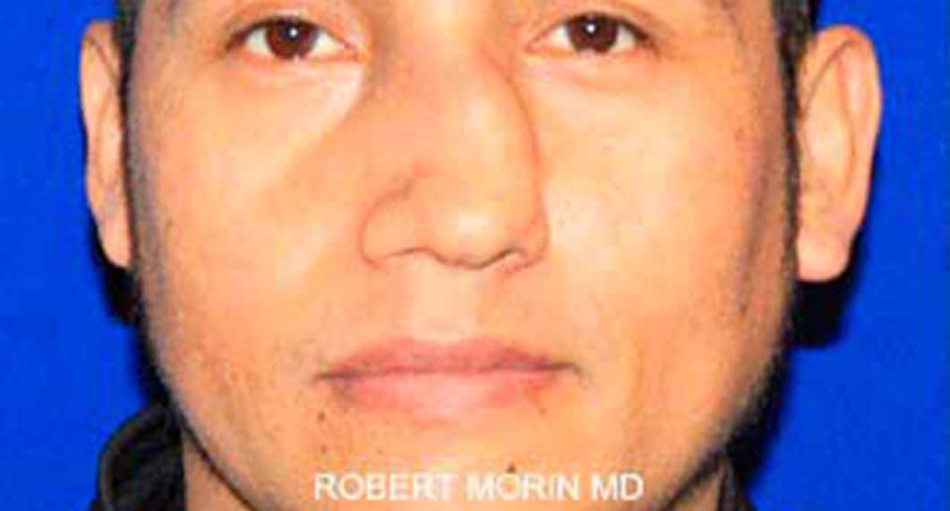 Facial fractures. Before Treatment photo - male patient 1