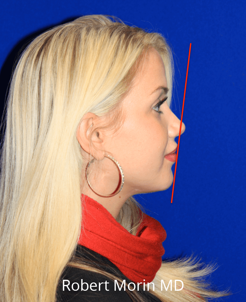 Genioplasty - Robert Morin MD - patient photo
