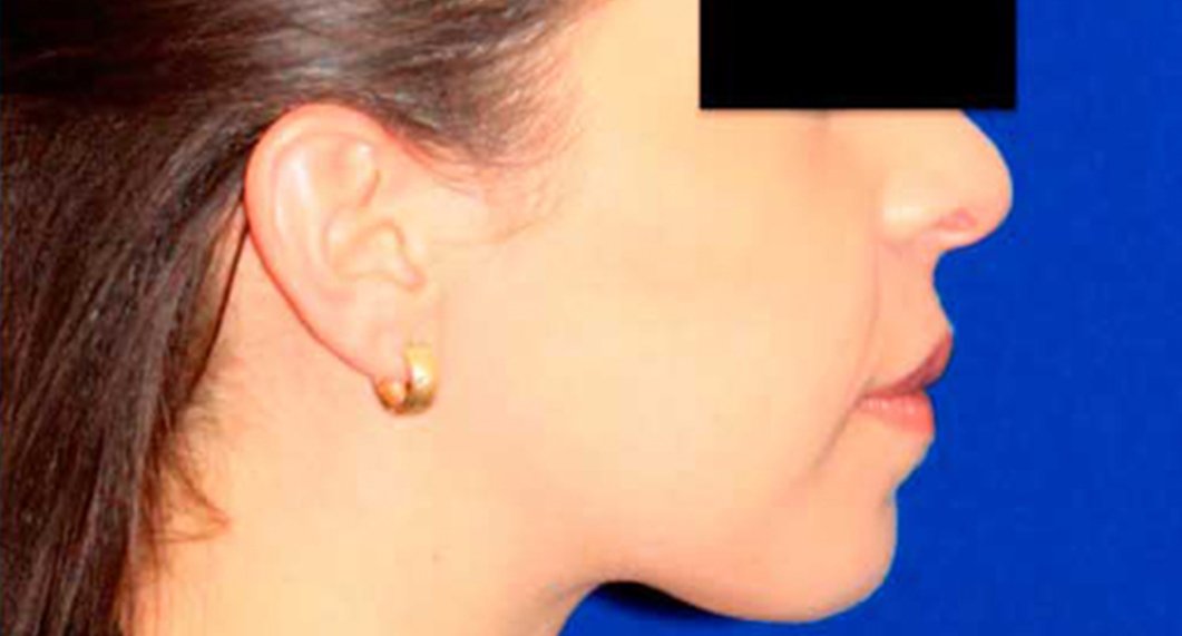 Genioplasty. After Treatment photo - patient 1