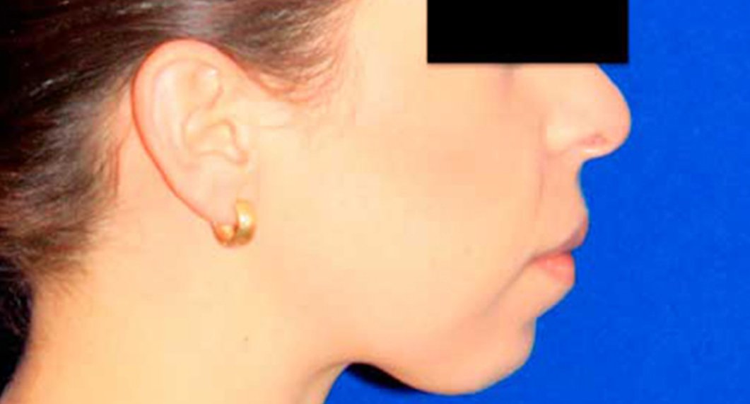 Genioplasty. Before Treatment photo - patient 1