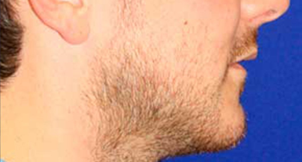 Genioplasty. After Treatment photo - patient 2