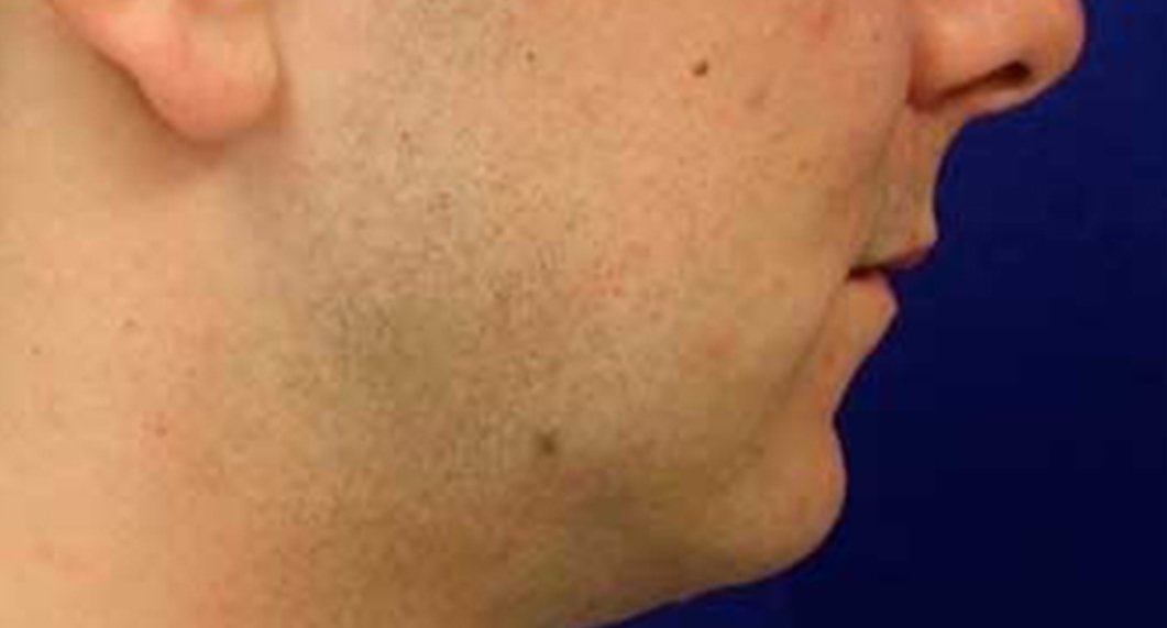 Genioplasty. Before Treatment photo - patient 2