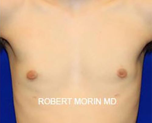 GYNECOMASTIA SURGERY, after treatment photo