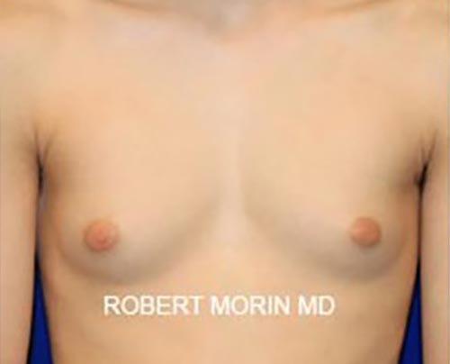 GYNECOMASTIA SURGERY, Before treatment photo
