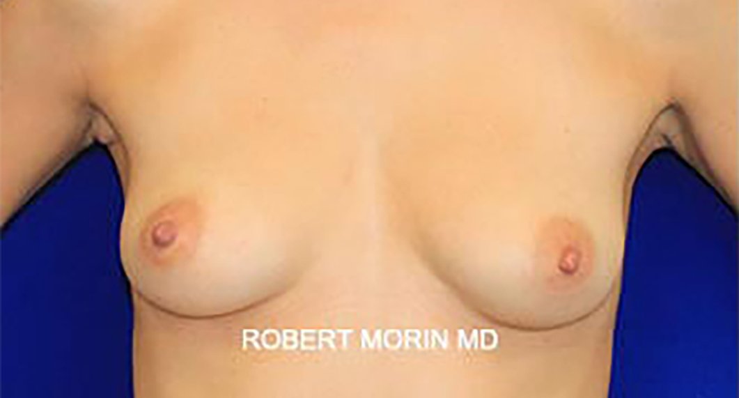 Breast Augmentation. Before Treatment photo - female patient 2