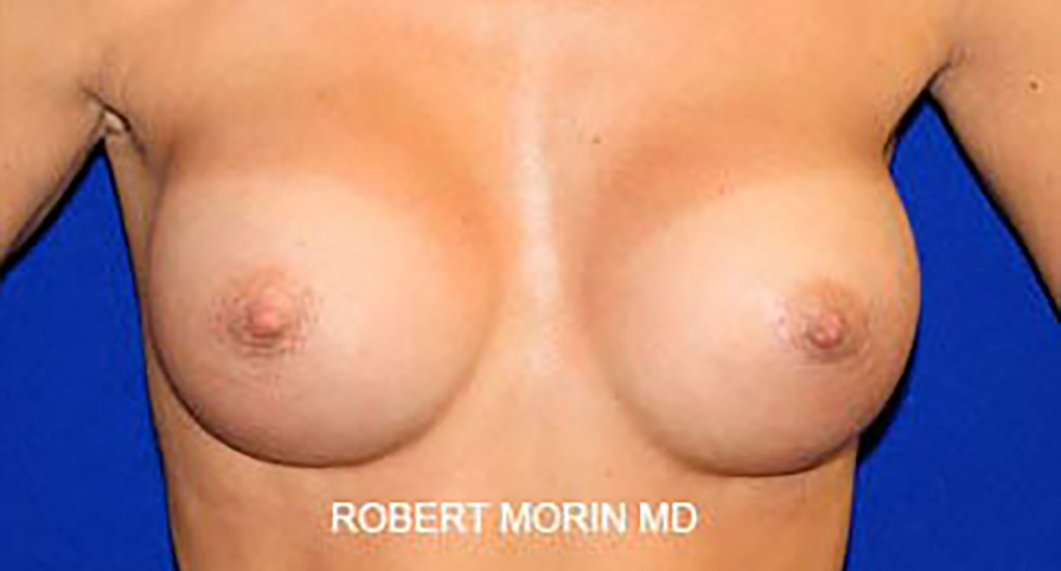 Breast Augmentation. After Treatment photo - female patient 3