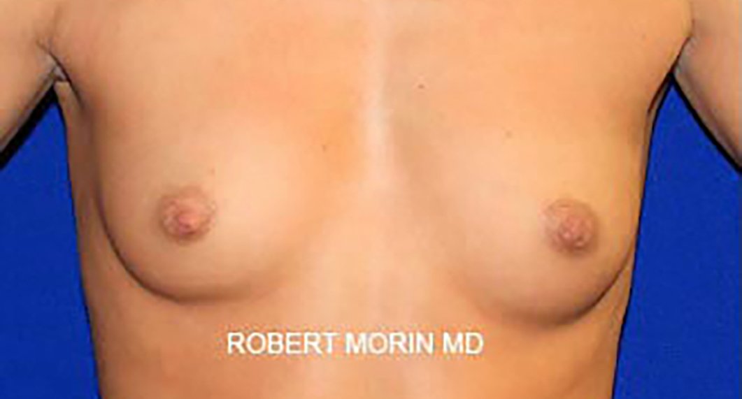 Breast Augmentation. Before Treatment photo - female patient 3