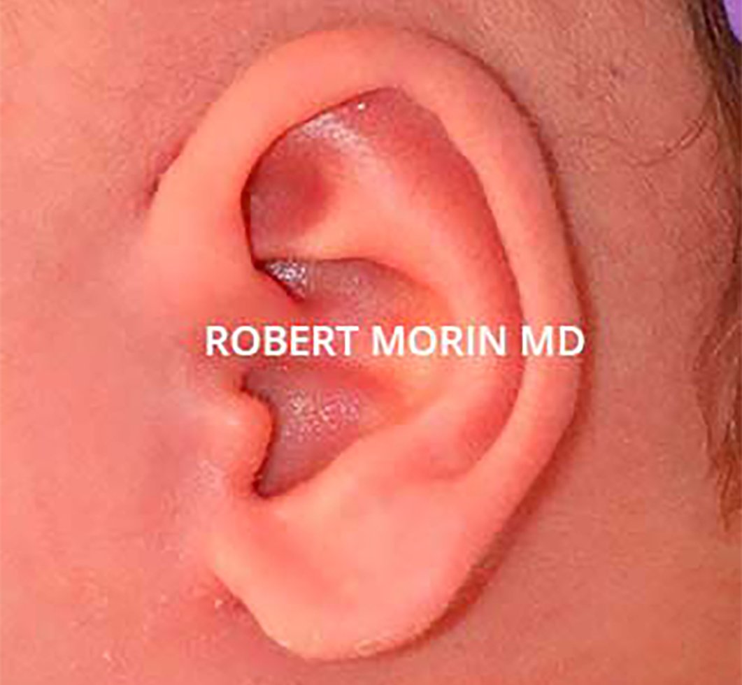 INFANT EAR MOLDING WITH THE EARWELL™ SYSTEM - little child, after treatment photo