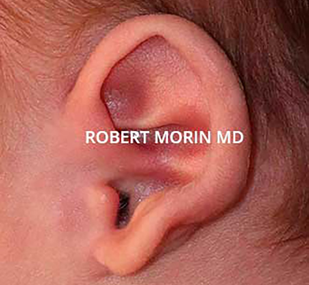 INFANT EAR MOLDING WITH THE EARWELL™ SYSTEM - little child, Before treatment photo