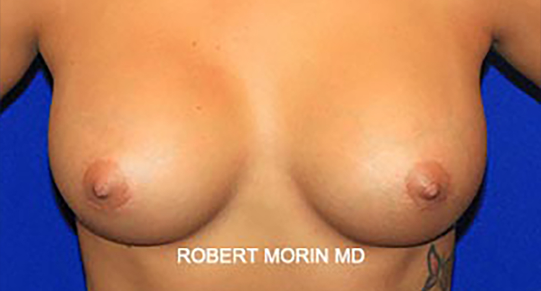 Woman's breasts, After Infra-Areolar Incision Breast Augmentation Treatment, front view, patient 1