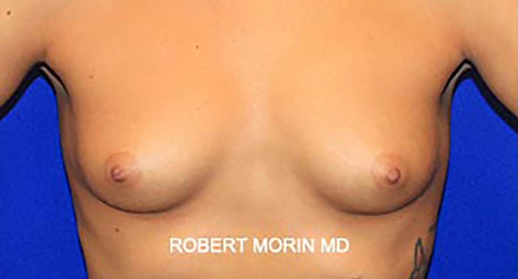 Woman's breasts, Before Infra-Areolar Incision Breast Augmentation Treatment, front view, patient 1
