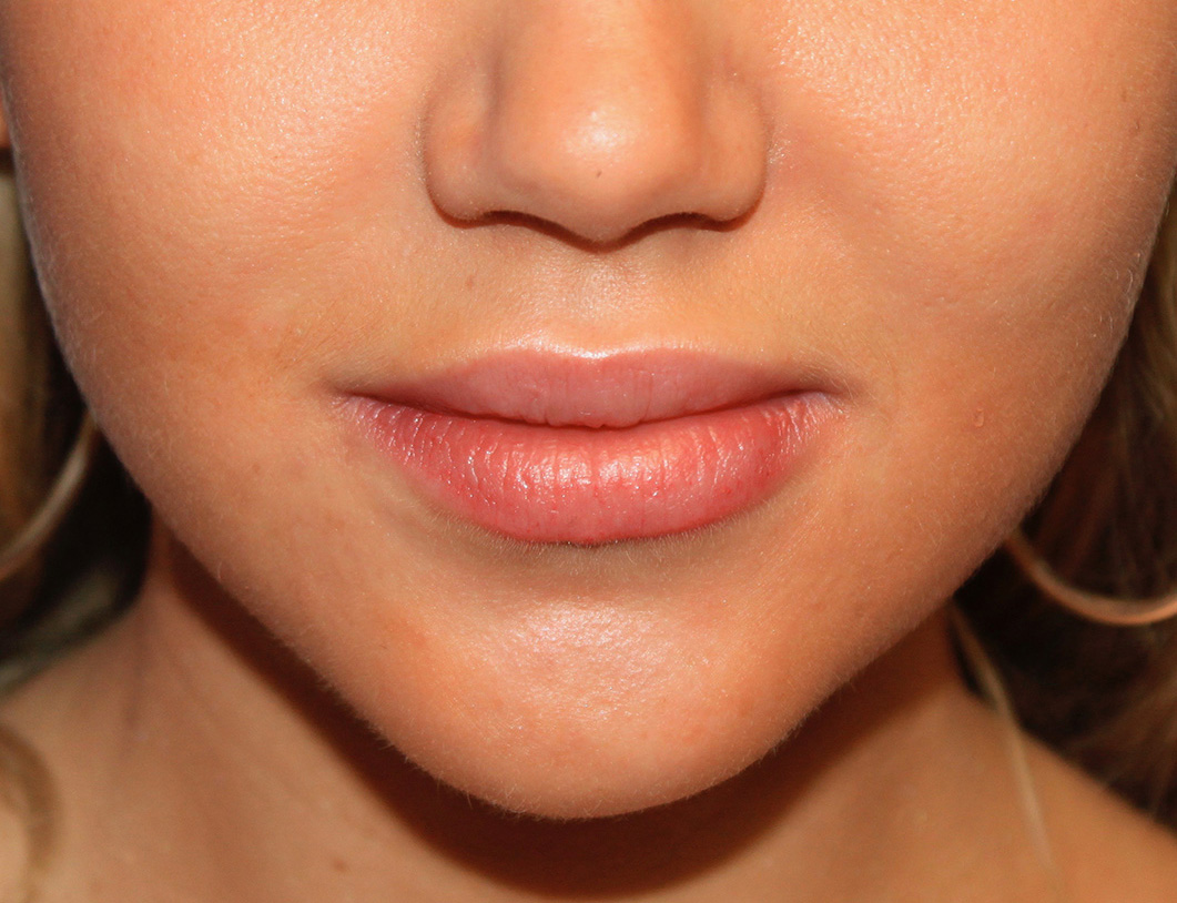 Lip augmentation. After Treatment photo - female patient 1