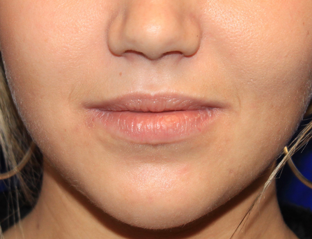 Lip augmentation. Before Treatment photo - female patient 1