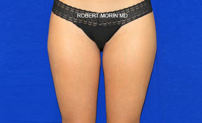 Liposuction . After Treatment photo - female patient 1